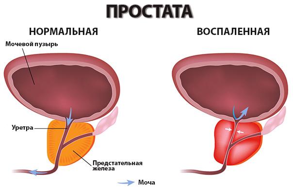 _и_воспаленная_простата.jpg