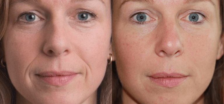 Состояние лица до и после косметологических процедур