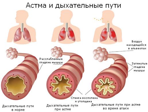 astma_and_airways.jpg