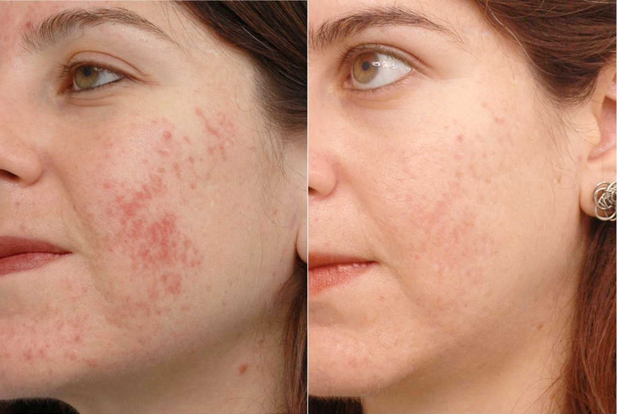 Состояние кожи при акне до и после процедуры