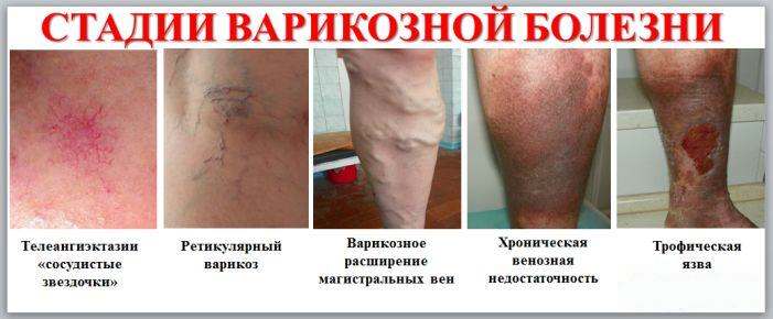 Крым лечение сосудов ног thumbnail